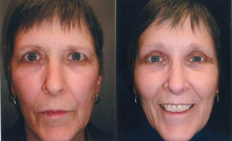 Blepharoplasty (Eyelid Surgery) before and after photo by Kristin J. Tarbet, M.D. in Bellevue, WA