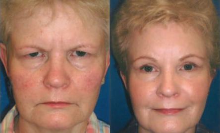 Blepharoplasty (Eyelid Surgery) before and after photo by Kristin J. Tarbet, M.D. in Bellevue, WA