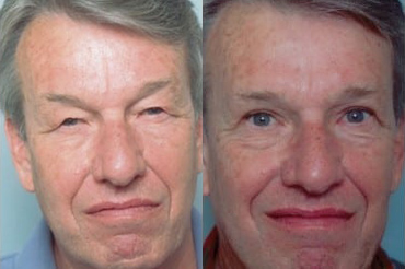 Blepharoplasty (Eyelid Surgery) before and after photo by Kristin J. Tarbet, M.D. in Bellevue, WA