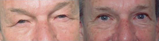 Blepharoplasty (Eyelid Surgery) before and after photo by Kristin J. Tarbet, M.D. in Bellevue, WA