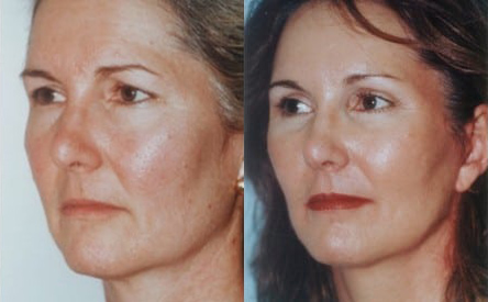 Blepharoplasty (Eyelid Surgery) before and after photo by Kristin J. Tarbet, M.D. in Bellevue, WA