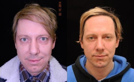 Blepharoplasty (Eyelid Surgery) before and after photo by Kristin J. Tarbet, M.D. in Bellevue, WA
