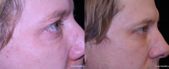Blepharoplasty (Eyelid Surgery) before and after photo by Kristin J. Tarbet, M.D. in Bellevue, WA