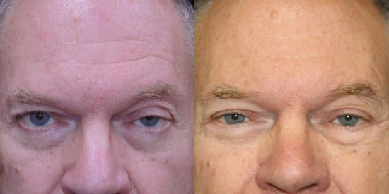 Blepharoplasty (Eyelid Surgery) before and after photo by Kristin J. Tarbet, M.D. in Bellevue, WA