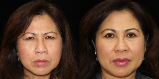 Blepharoplasty (Eyelid Surgery) before and after photo by Kristin J. Tarbet, M.D. in Bellevue, WA