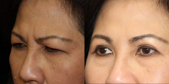 Blepharoplasty (Eyelid Surgery) before and after photo by Kristin J. Tarbet, M.D. in Bellevue, WA