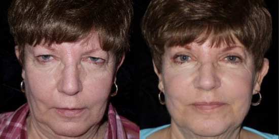 Blepharoplasty (Eyelid Surgery) before and after photo by Kristin J. Tarbet, M.D. in Bellevue, WA