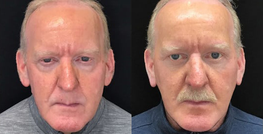 Blepharoplasty (Eyelid Surgery) before and after photo by Kristin J. Tarbet, M.D. in Bellevue, WA
