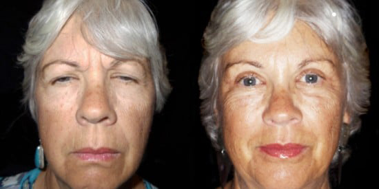 Blepharoplasty (Eyelid Surgery) before and after photo by Kristin J. Tarbet, M.D. in Bellevue, WA