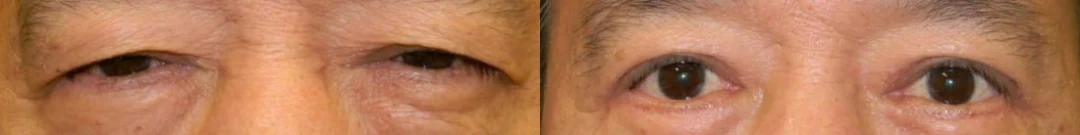 Blepharoplasty (Eyelid Surgery) before and after photo by Kristin J. Tarbet, M.D. in Bellevue, WA