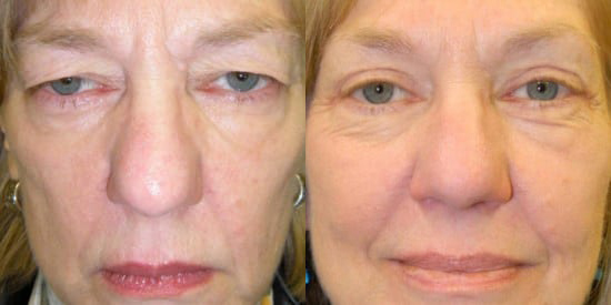 Blepharoplasty (Eyelid Surgery) before and after photo by Kristin J. Tarbet, M.D. in Bellevue, WA