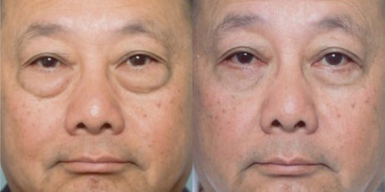 Blepharoplasty (Eyelid Surgery) before and after photo by Kristin J. Tarbet, M.D. in Bellevue, WA