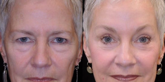 Blepharoplasty (Eyelid Surgery) before and after photo by Kristin J. Tarbet, M.D. in Bellevue, WA