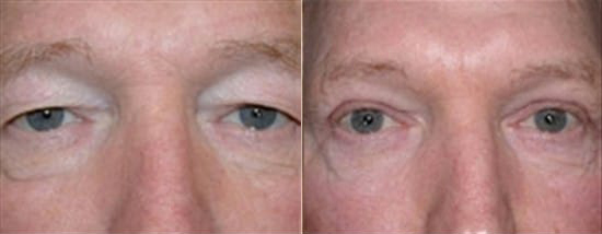 Blepharoplasty (Eyelid Surgery) before and after photo by Kristin J. Tarbet, M.D. in Bellevue, WA