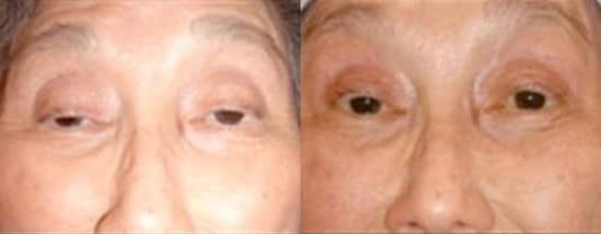 Blepharoplasty (Eyelid Surgery) before and after photo by Kristin J. Tarbet, M.D. in Bellevue, WA