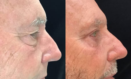Blepharoplasty (Eyelid Surgery) before and after photo by Kristin J. Tarbet, M.D. in Bellevue, WA