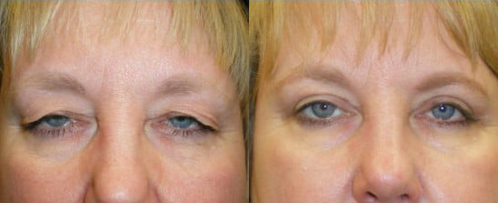 Blepharoplasty (Eyelid Surgery) before and after photo by Kristin J. Tarbet, M.D. in Bellevue, WA