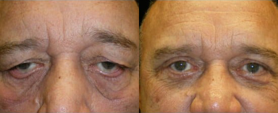 Blepharoplasty (Eyelid Surgery) before and after photo by Kristin J. Tarbet, M.D. in Bellevue, WA