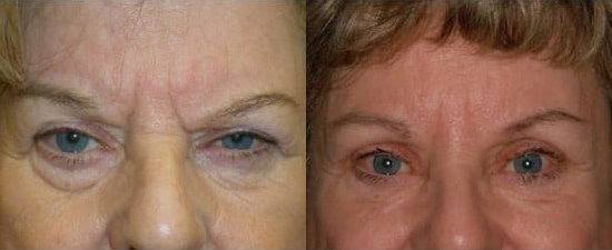 Blepharoplasty (Eyelid Surgery) before and after photo by Kristin J. Tarbet, M.D. in Bellevue, WA