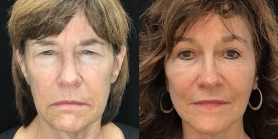 Blepharoplasty (Eyelid Surgery) before and after photo by Kristin J. Tarbet, M.D. in Bellevue, WA