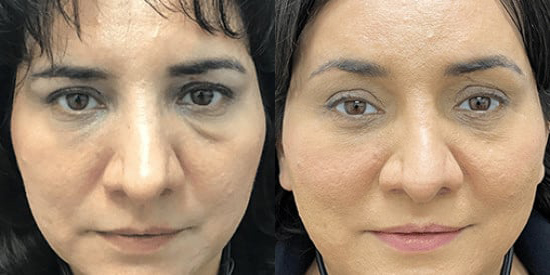 Blepharoplasty (Eyelid Surgery) before and after photo by Kristin J. Tarbet, M.D. in Bellevue, WA