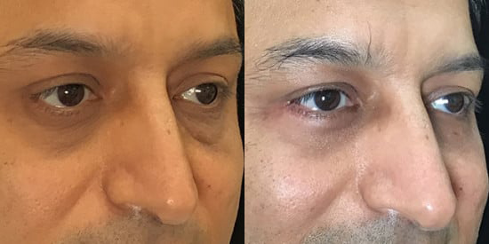Blepharoplasty (Eyelid Surgery) before and after photo by Kristin J. Tarbet, M.D. in Bellevue, WA