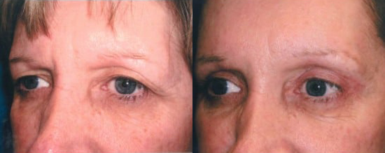 Brow Lift before and after photo by Kristin J. Tarbet, M.D. in Bellevue, WA