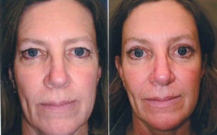 Brow Lift before and after photo by Kristin J. Tarbet, M.D. in Bellevue, WA
