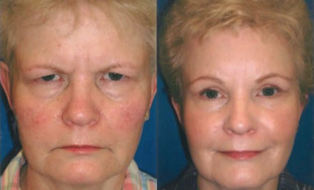 Brow Lift before and after photo by Kristin J. Tarbet, M.D. in Bellevue, WA