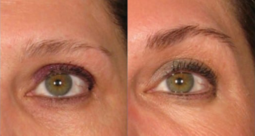 Brow Lift before and after photo by Kristin J. Tarbet, M.D. in Bellevue, WA