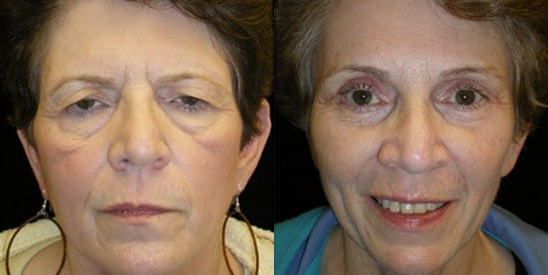 Brow Lift before and after photo by Kristin J. Tarbet, M.D. in Bellevue, WA