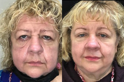 Brow Lift before and after photo by Kristin J. Tarbet, M.D. in Bellevue, WA