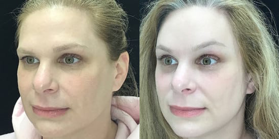 Brow Lift before and after photo by Kristin J. Tarbet, M.D. in Bellevue, WA