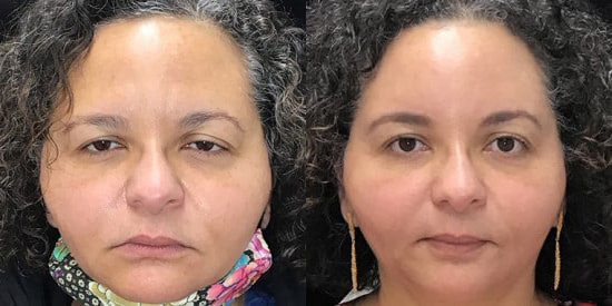 Brow Lift before and after photo by Kristin J. Tarbet, M.D. in Bellevue, WA