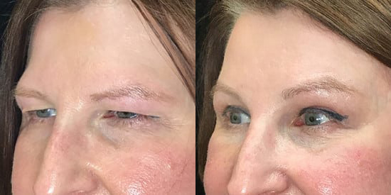 Brow Lift before and after photo by Kristin J. Tarbet, M.D. in Bellevue, WA