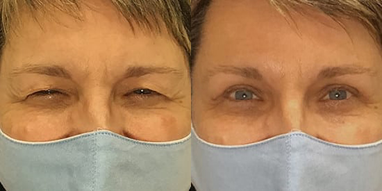 Brow Lift before and after photo by Kristin J. Tarbet, M.D. in Bellevue, WA