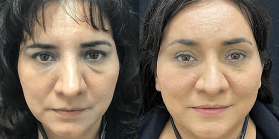 Brow Lift before and after photo by Kristin J. Tarbet, M.D. in Bellevue, WA