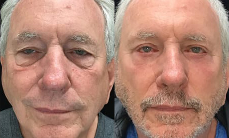 Cheeklift before and after photo by Kristin J. Tarbet, M.D. in Bellevue, WA