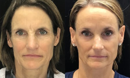 Cheeklift before and after photo by Kristin J. Tarbet, M.D. in Bellevue, WA