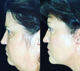 Facelift before and after photo by Kristin J. Tarbet, M.D. in Bellevue, WA
