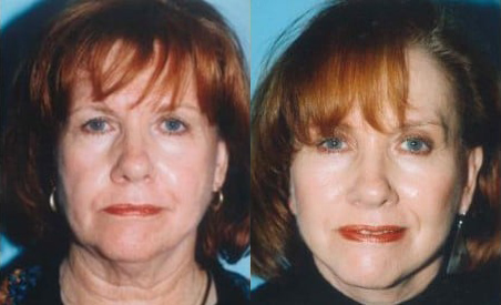 Facelift before and after photo by Kristin J. Tarbet, M.D. in Bellevue, WA