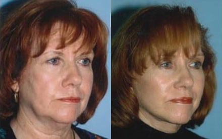 Facelift before and after photo by Kristin J. Tarbet, M.D. in Bellevue, WA