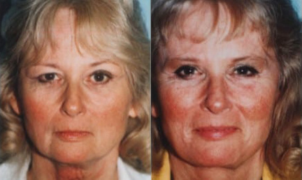 Facelift before and after photo by Kristin J. Tarbet, M.D. in Bellevue, WA