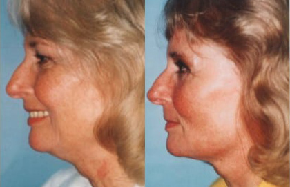 Facelift before and after photo by Kristin J. Tarbet, M.D. in Bellevue, WA