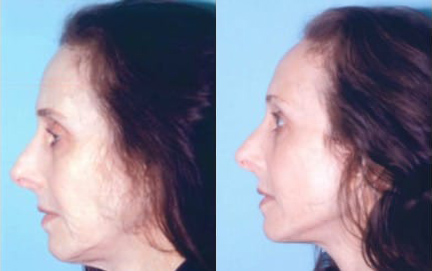 Facelift before and after photo by Kristin J. Tarbet, M.D. in Bellevue, WA