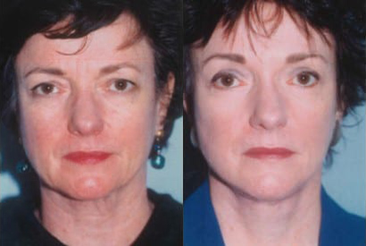 Facelift before and after photo by Kristin J. Tarbet, M.D. in Bellevue, WA