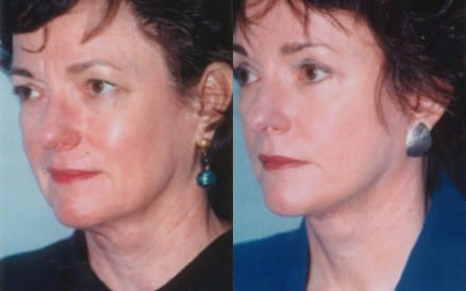 Facelift before and after photo by Kristin J. Tarbet, M.D. in Bellevue, WA