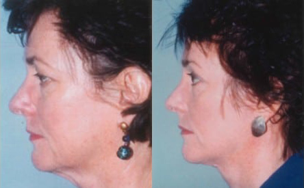 Facelift before and after photo by Kristin J. Tarbet, M.D. in Bellevue, WA