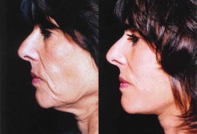 Facelift before and after photo by Kristin J. Tarbet, M.D. in Bellevue, WA