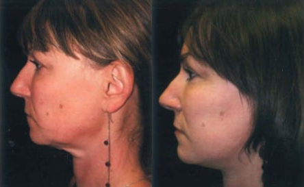 Facelift before and after photo by Kristin J. Tarbet, M.D. in Bellevue, WA